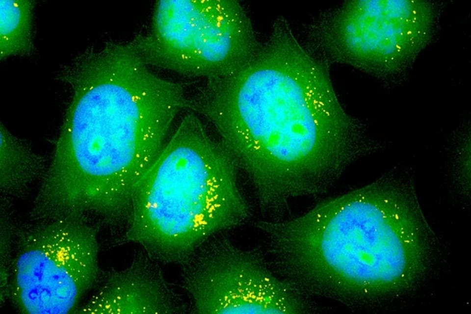 吸入式mRNA疗法： cystic fibrosis 治疗新纪元